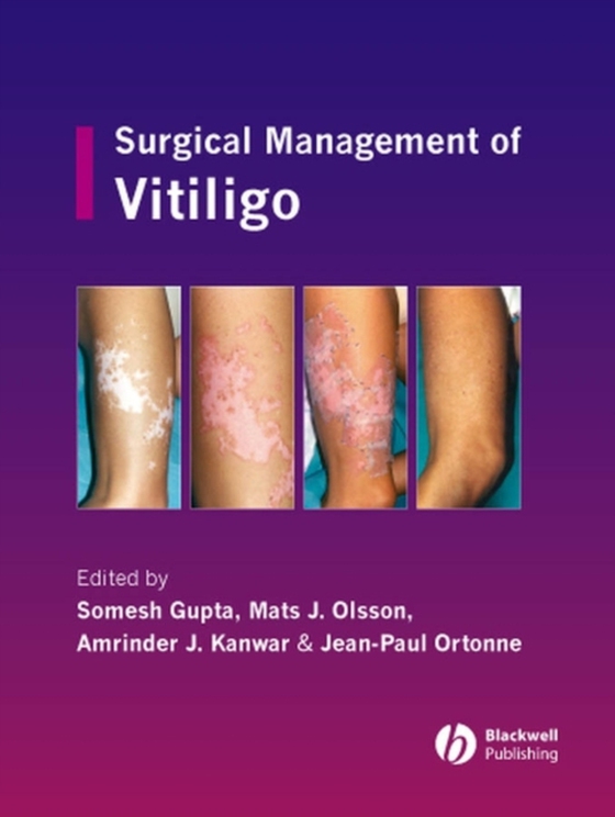 Surgical Management of Vitiligo (e-bog) af -