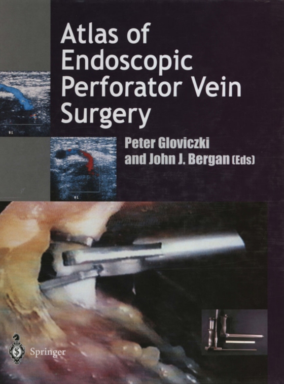 Atlas of Endoscopic Perforator Vein Surgery (e-bog) af -