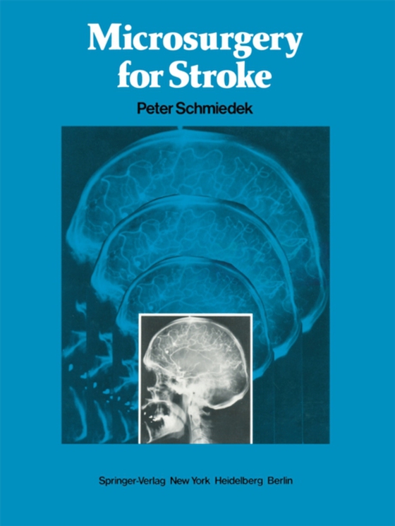 Microsurgery for Stroke (e-bog) af -