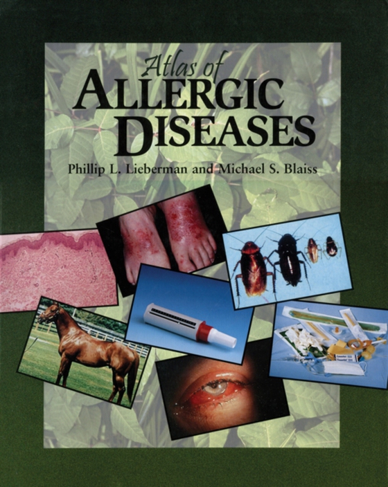 Atlas of Allergic Diseases (e-bog) af -