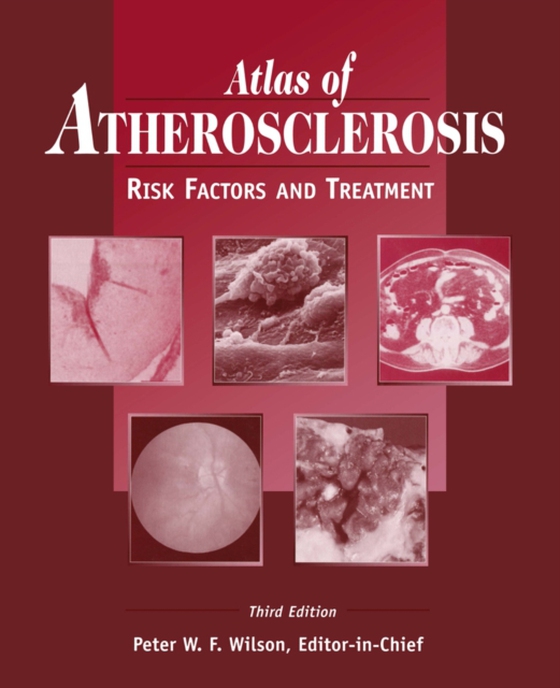 Atlas of Atherosclerosis (e-bog) af -