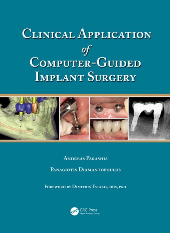 Clinical Application of Computer-Guided Implant Surgery (e-bog) af Diamantopoulos, Panagiotis