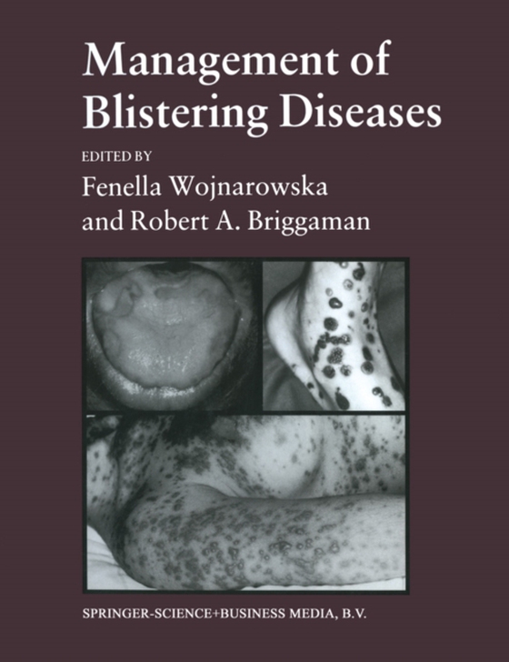 Management of Blistering Diseases (e-bog) af Wojnarowska, Robert A. Briggaman Fenella