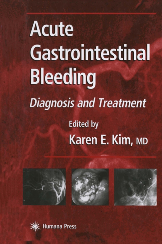 Acute Gastrointestinal Bleeding