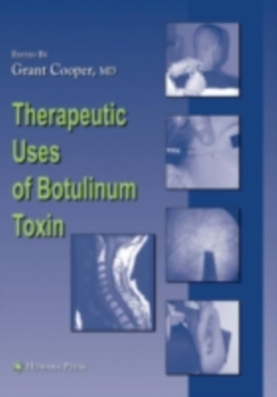 Therapeutic Uses of Botulinum Toxin (e-bog) af -