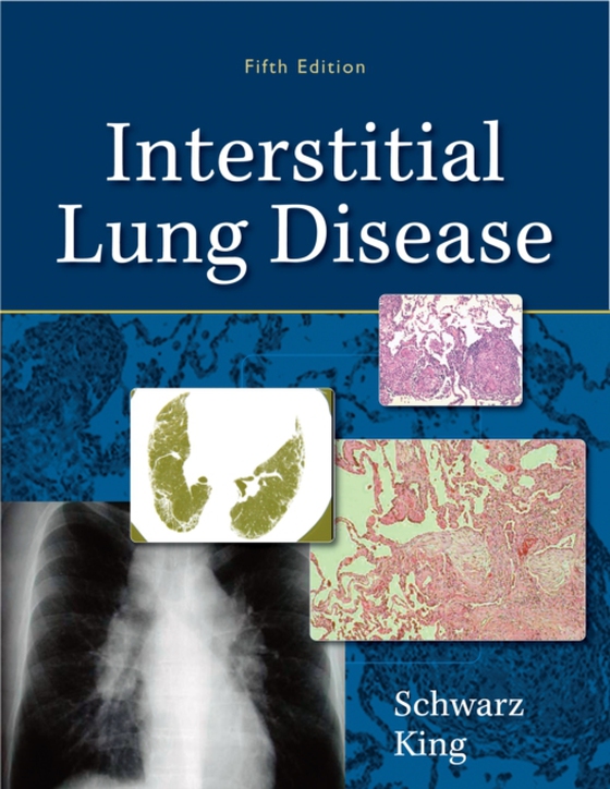 Interstitial Lung Disease (e-bog) af -