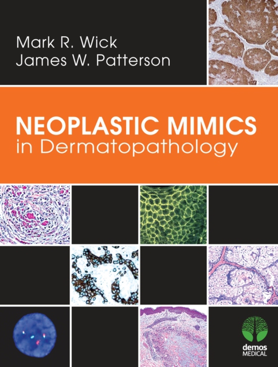 Neoplastic Mimics in Dermatopathology (e-bog) af James W. Patterson, MD