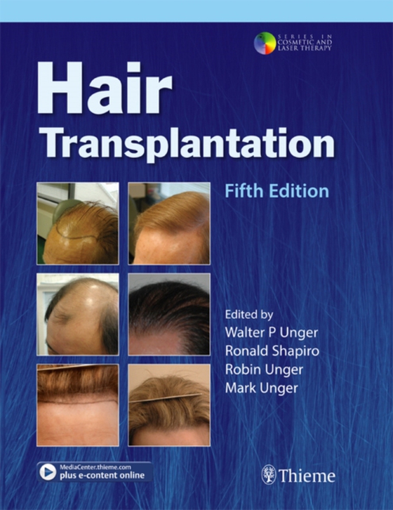 Hair Transplantation (e-bog) af -