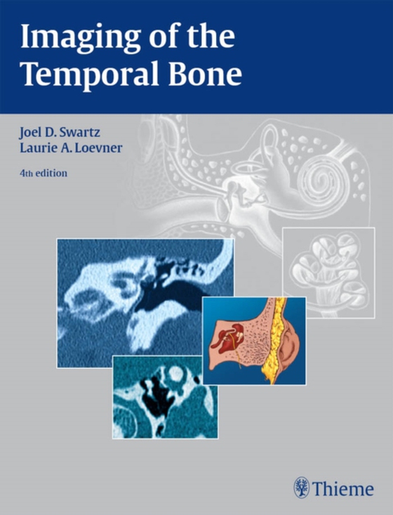 Imaging of the Temporal Bone