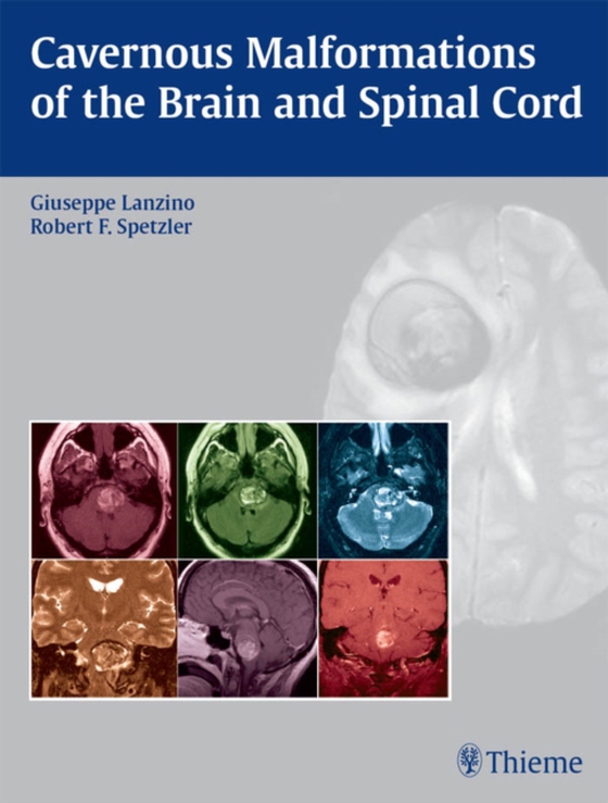 Cavernous Malformations of the Brain and Spinal Cord (e-bog) af -