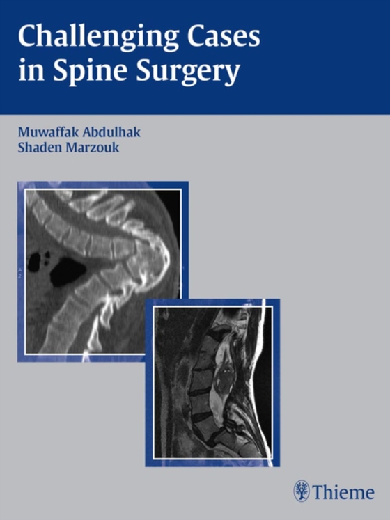 Challenging Cases in Spine Surgery (e-bog) af -