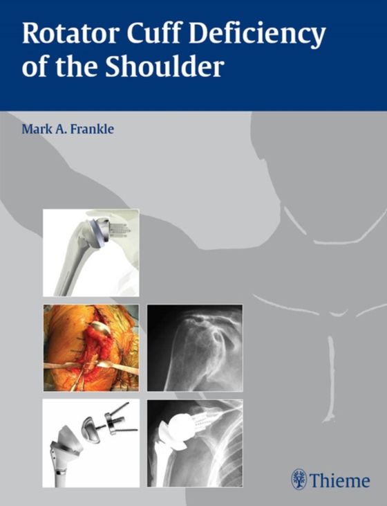 Rotator Cuff Deficiency of the Shoulder (e-bog) af -