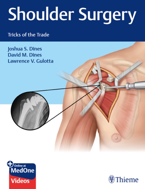 Shoulder Surgery (e-bog) af Gulotta, Lawrence V.