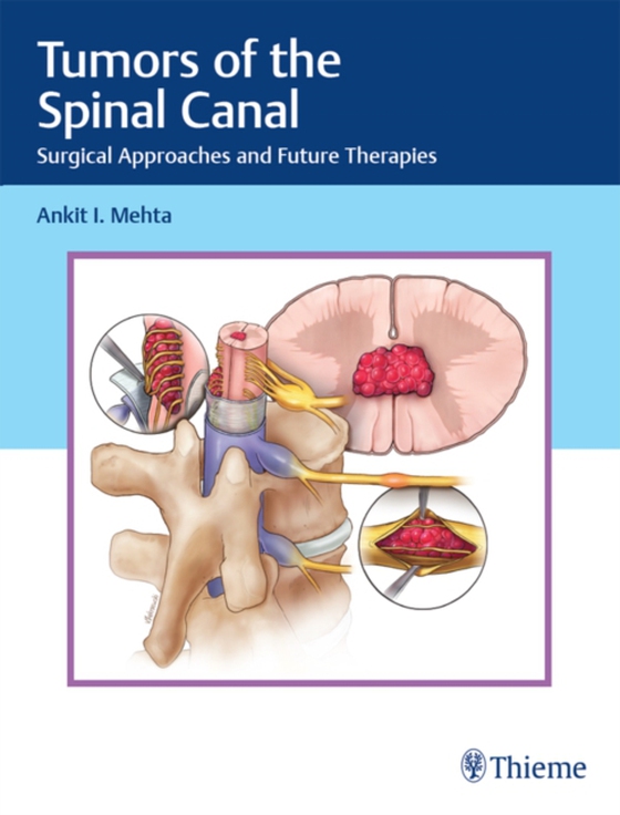 Tumors of the Spinal Canal