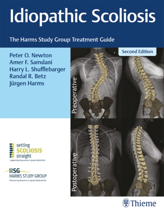 Idiopathic Scoliosis