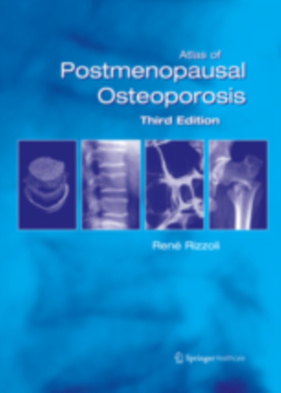 Atlas of Postmenopausal Osteoporosis (e-bog) af -