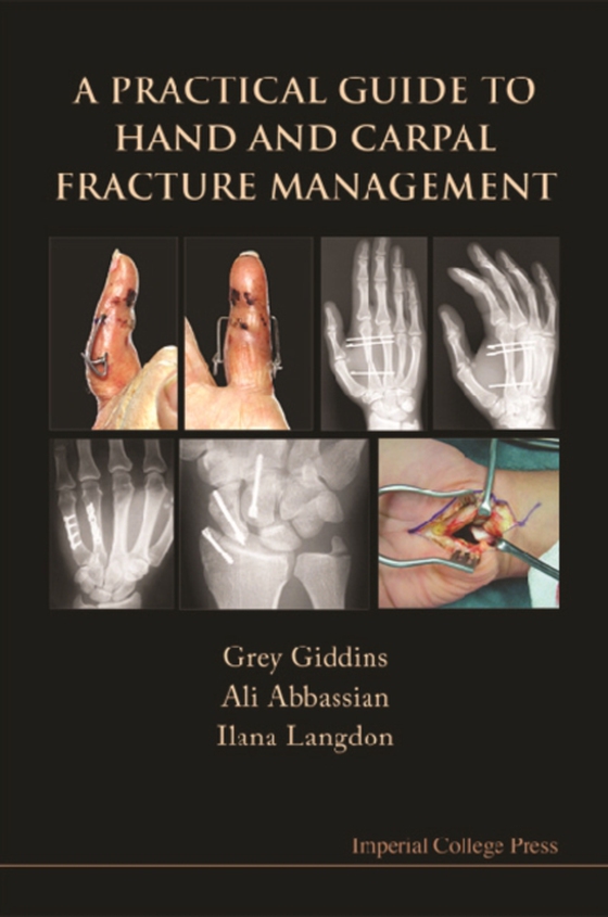 Practical Guide To Hand And Carpal Fracture Management, A (e-bog) af Ilana Langdon, Langdon