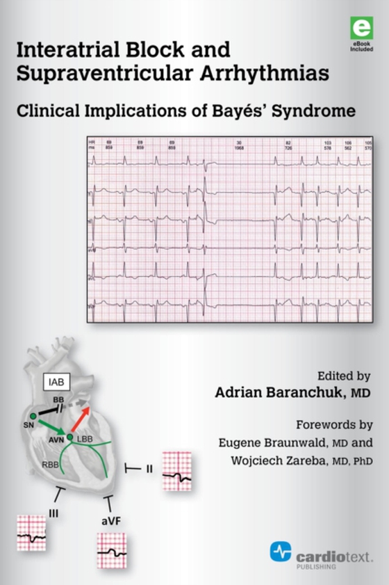 Interatrial Block and Supraventricular Arrhythmias: Clinical Implications of Bayes Syndrome (e-bog) af -