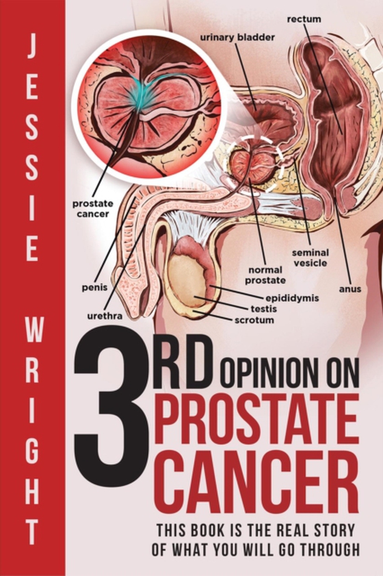 3rd Opinion on Prostate Cancer (e-bog) af Wright, Jessie