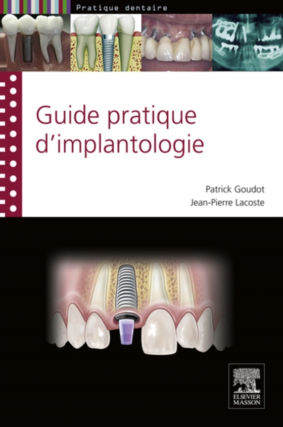 guide pratique d'implantologie (e-bog) af Lacoste, Jean-Pierre