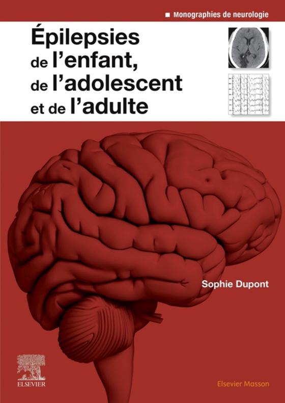 Epilepsies de l'enfant, de l'adolescent et de l'adulte (e-bog) af Dupont, Sophie