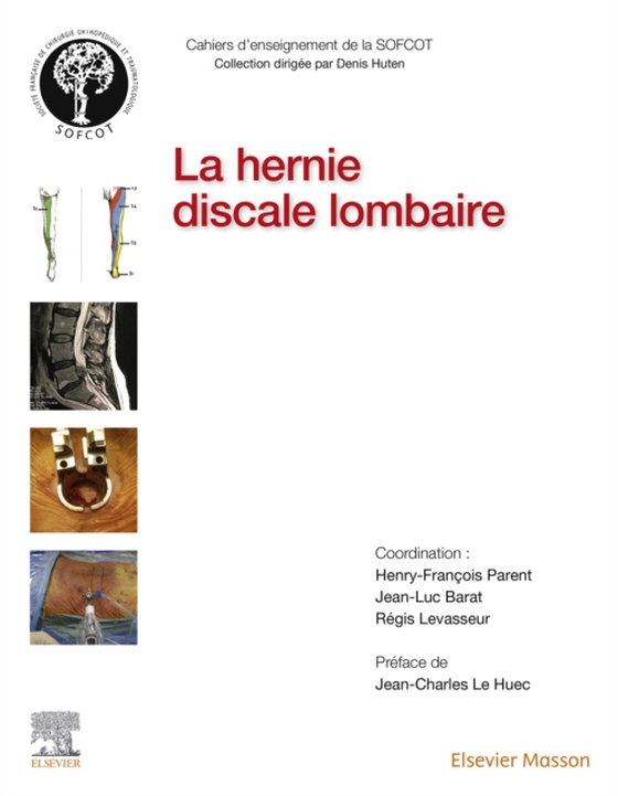 La hernie discale lombaire