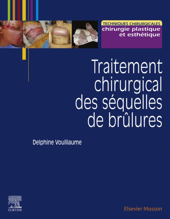 Traitement chirurgical des séquelles de brûlures (e-bog) af Voulliaume, Delphine