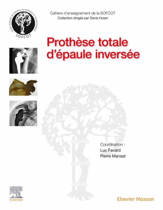 Prothèse totale d'épaule inversée