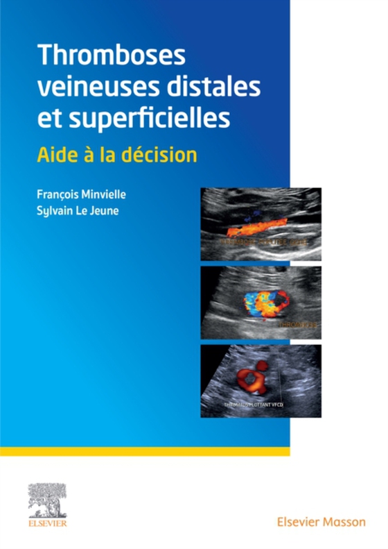 Thromboses veineuses distales et superficielles (e-bog) af Minvielle, Francois