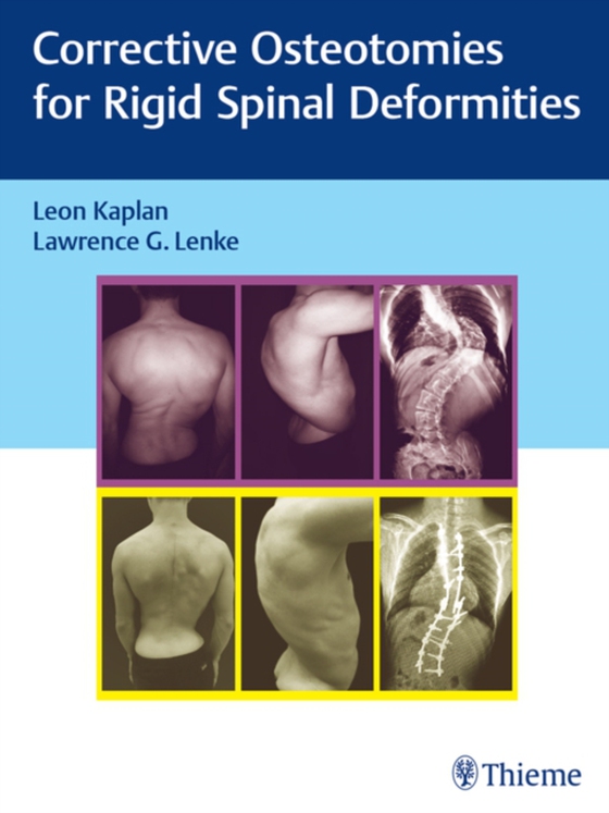 Corrective Osteotomies for Rigid Spinal Deformities (e-bog) af -