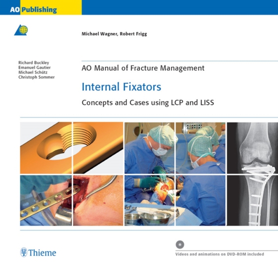 AO Manual of Fracture Management: Internal Fixators (e-bog) af Frigg, Robert