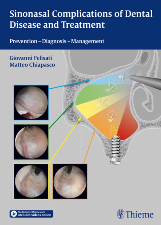 Sinonasal Complications of Dental Disease and Treatment (e-bog) af -