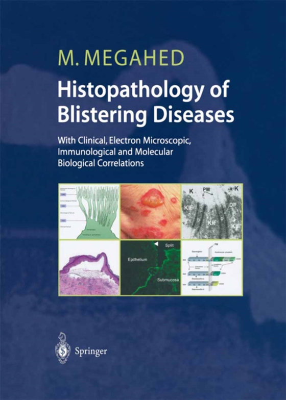 Histopathology of Blistering Diseases (e-bog) af Megahed, Mosaad