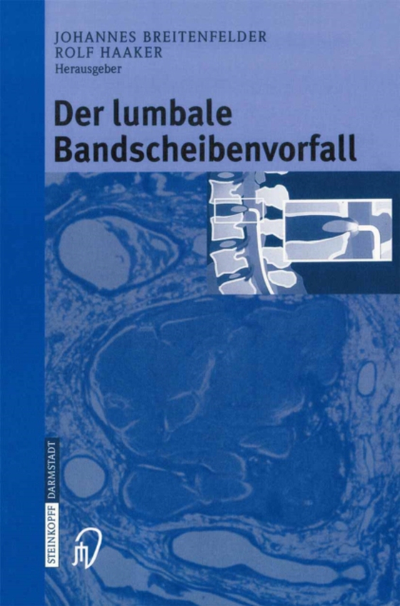 Der lumbale Bandscheibenvorfall (e-bog) af -