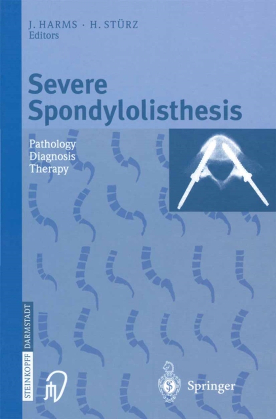 Severe Spondylolisthesis (e-bog) af -