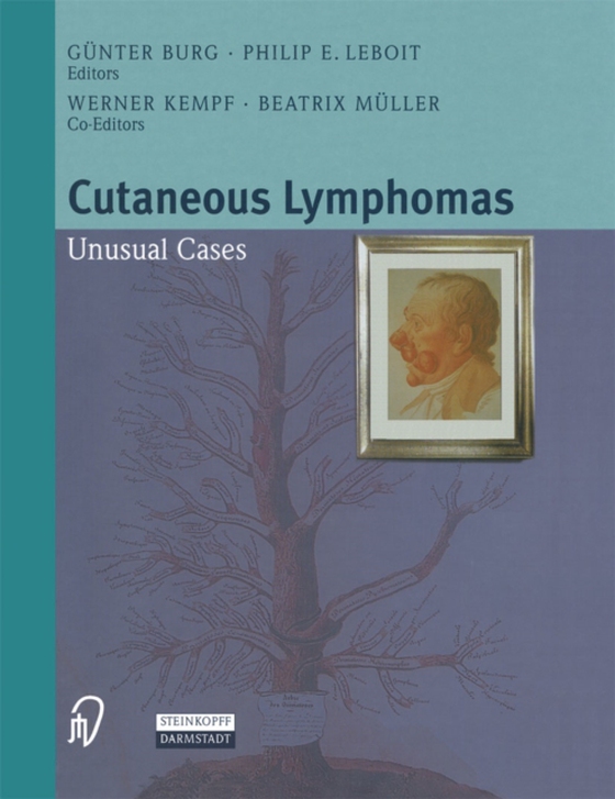 Cutaneous Lymphomas (e-bog) af -