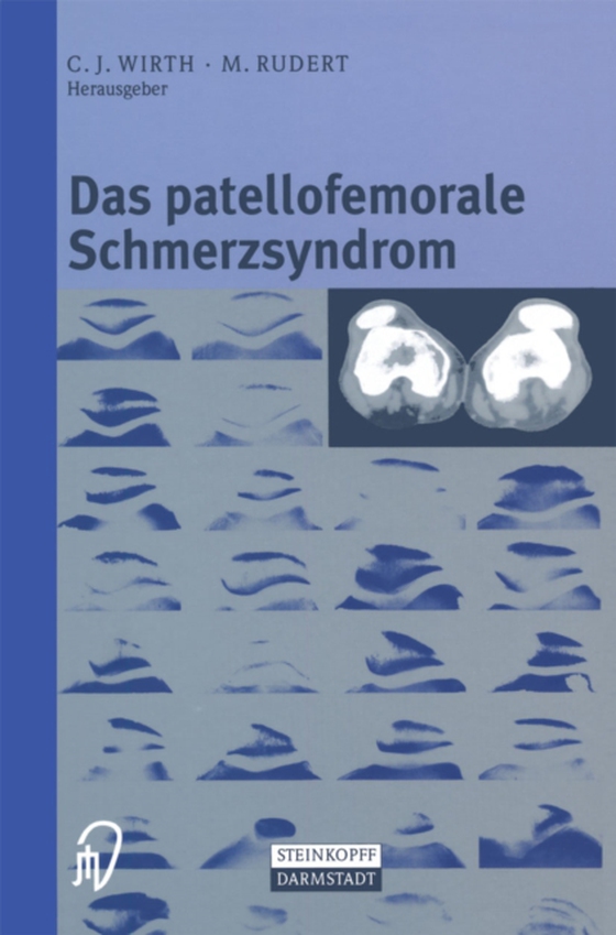 Das patellofemorale Schmerzsyndrom