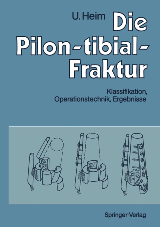 Die Pilon-tibial-Fraktur (e-bog) af Heim, Urs