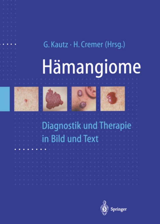 Hämangiome (e-bog) af -