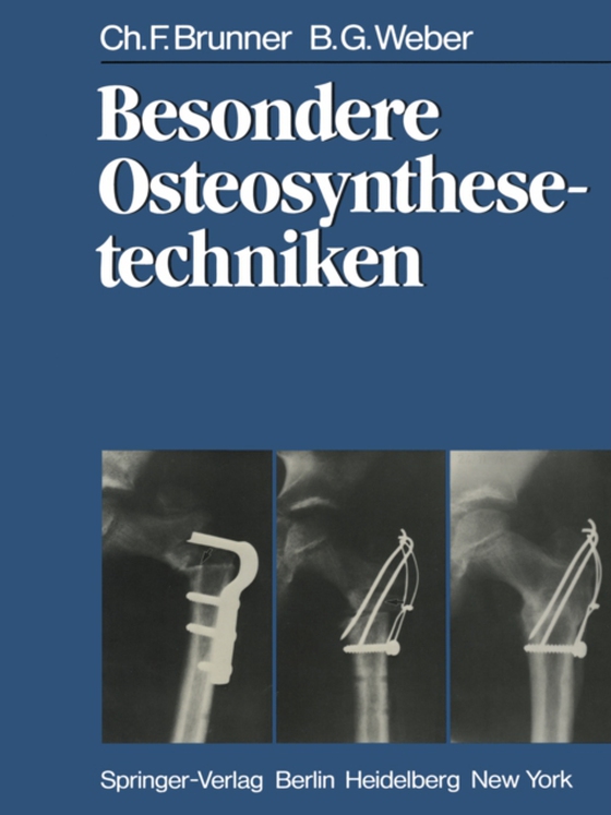 Besondere Osteosynthesetechniken (e-bog) af Weber, B. G.