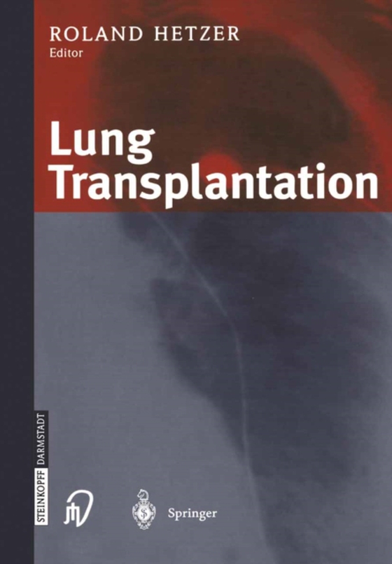 Lung Transplantation (e-bog) af -