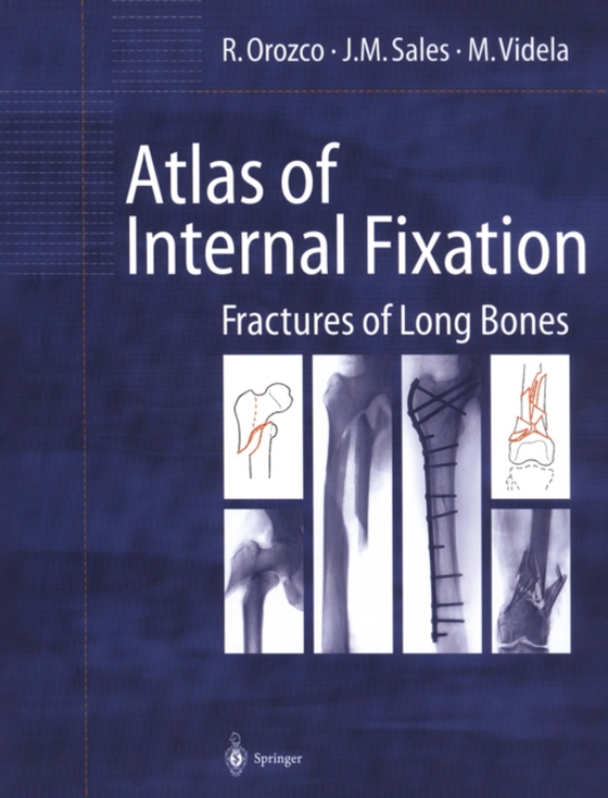 Atlas of Internal Fixation (e-bog) af Videla, M.