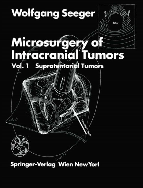 Microsurgery of Intracranial Tumors