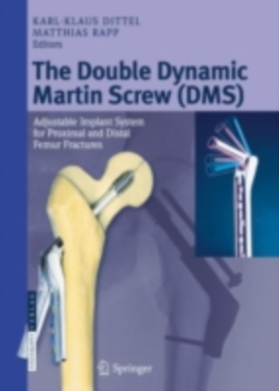 Double Dynamic Martin Screw (DMS) (e-bog) af -