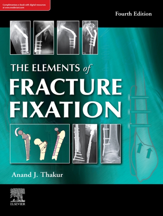 elements of fracture fixation, 4e (e-bog) af Thakur, Anand J.