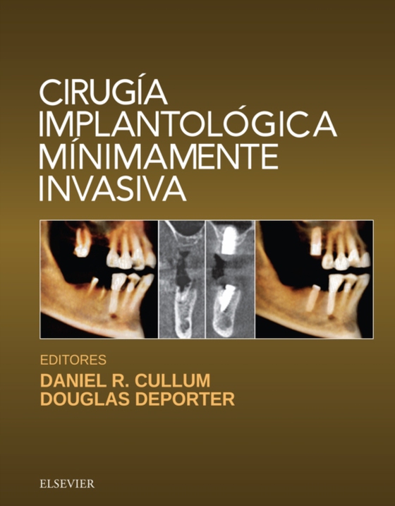 Cirugía implantológica mínimamente invasiva (e-bog) af -