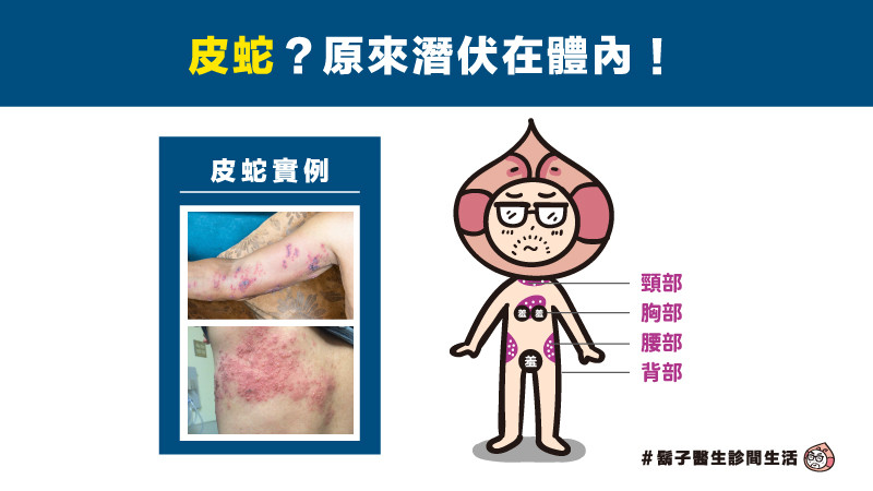 什麼是皮蛇?跟水痘有關係嗎? 什麼是皮蛇?跟水痘有關係嗎?