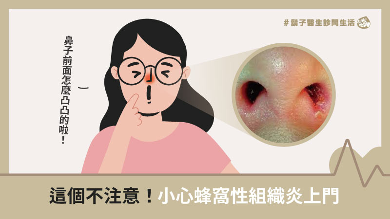 鼻孔內紅熱發炎 小心鼻前庭炎 親子天下
