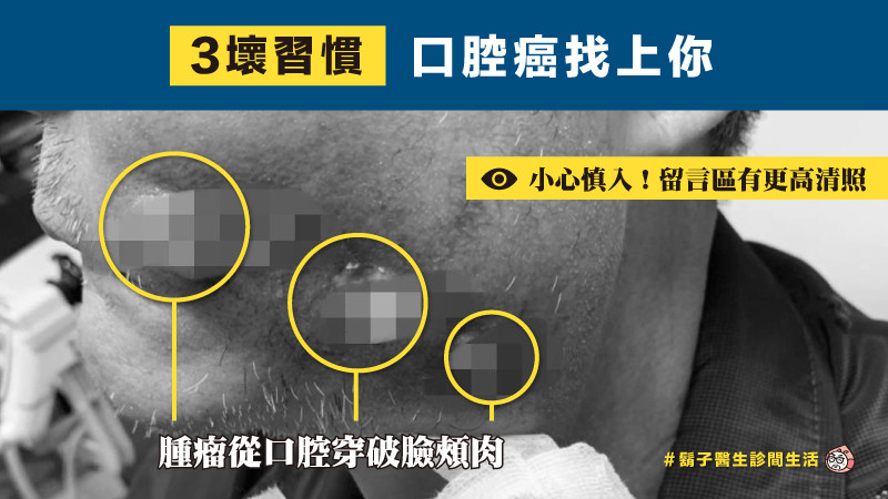 3個壞習慣,口腔癌找上你 3個壞習慣,口腔癌找上你