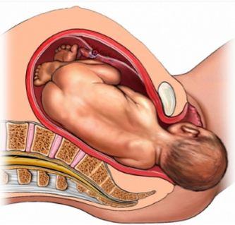 Schouderdystocie: Alles wat je moet weten